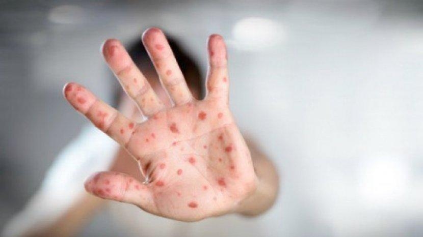 Kasus Monkeypox Meningkat, Ternyata Dipicu Perilaku Seksual Tak Sehat