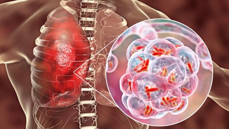 Warga Kota Tangerang Diimbau Jangan Panik dengan Kasus Pneumonia 