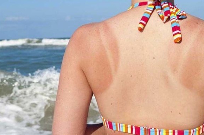 Catat! Ini Cara Mencegah Kulit Belang saat Berlibur di Pantai