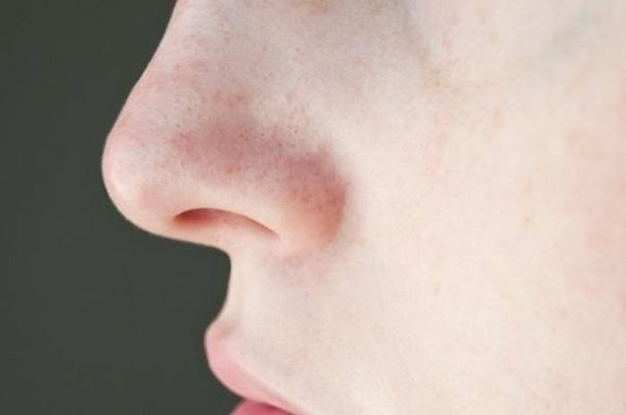Ampuh! Ini Cara Menghilangkan Komedo di Hidung Secara Cepat dan Alami