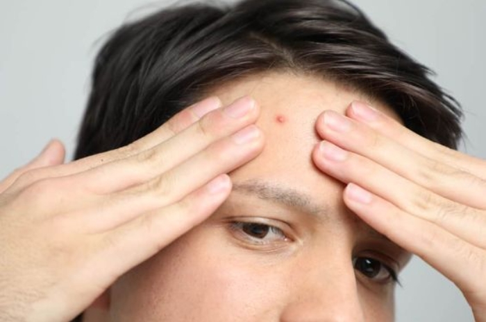 Cara Menghilangkan Jerawat Pakai Bawang Putih, Bye Perawatan Dokter Kecantikan