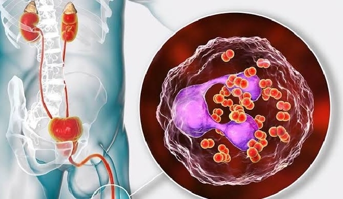 Kasus Kencing Nanah Marak di Kalangan Remaja, Stok Obat Makin Menipis