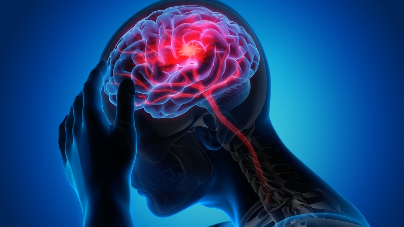 Kenali gejala stroke sejak dini untuk mencegah kerusakan yang lebih parah!