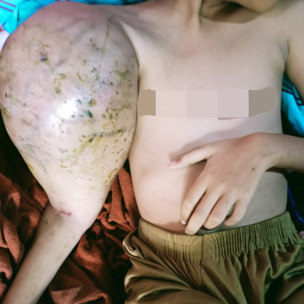 Anak 10 Tahun Alami Kanker Ganas, Orang Tua Sebut Kejadian Usai Vaksinasi di Sekolah