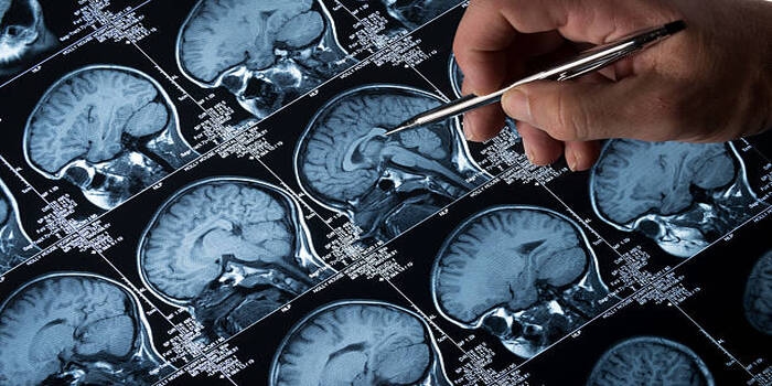 Uji Klinis di Tiongkok Hasilkan Harapan Baru bagi Pasien Tumor Otak