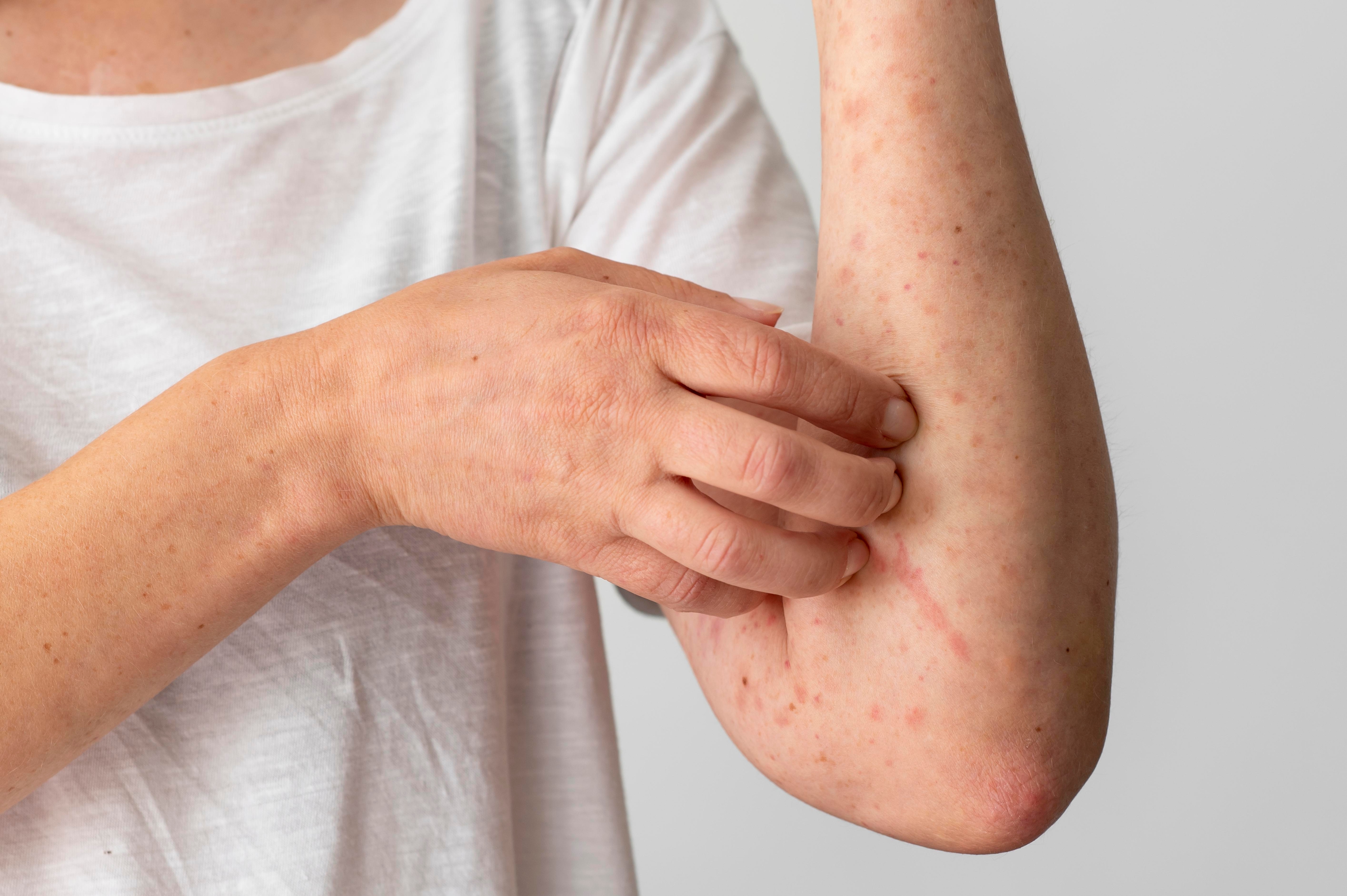 Ada Vaksin Lyme Disease di Indonesia? Begini Fakta Sebenarnya dari Pakar
